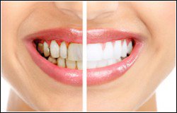 teeth-whitening